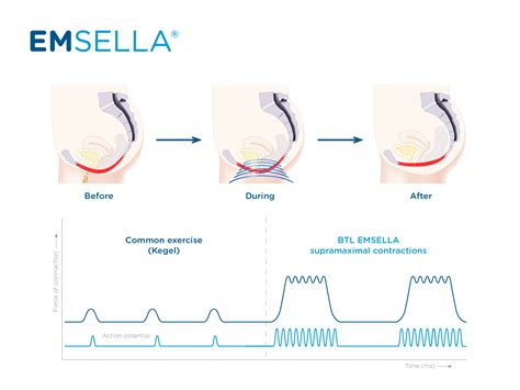 Emsella Urinary Incontinence Treatment The Retreat Medical Spa