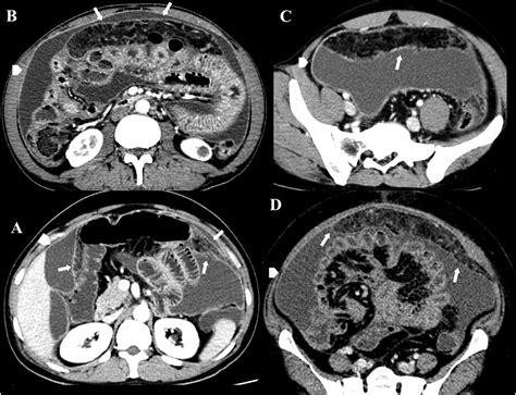 Differentiation Of Peritoneal Tuberculosis From Peritoneal