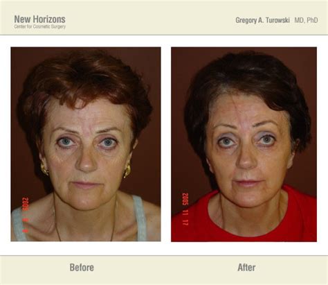 Laser Resurfacing Before And After Pictures Dr Turowski Plastic Surgery Chicago