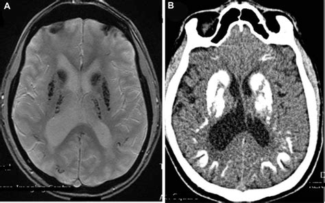 A Magnetic Resonance Axial Section T Gre Sequence With Extensive