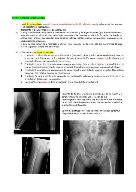 Seminario Artritis Tuberculosa Xiomara Hinostroza Udocz