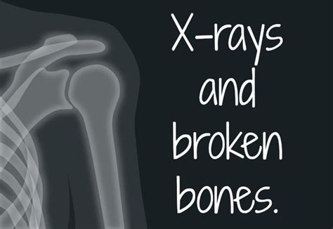 Northumberland Mam: X-rays and broken bones. #Blogtober18