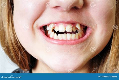 Bad Teeth Stock Photography Image 13398592