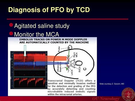 Ppt Introduction To Carotid Ultrasound And Transcranial Doppler