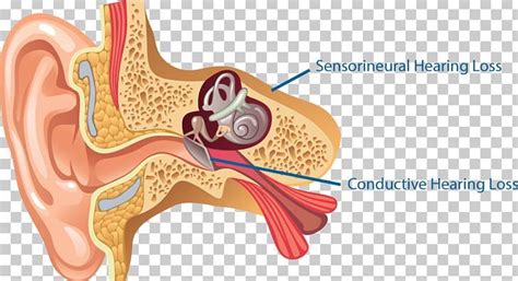 Middle Ear, The Middle, Ear Anatomy, Ear Wax, Hearing Loss, Free Sign ...