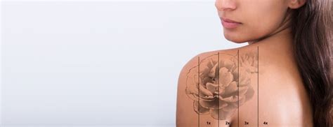 Laser Tattoo Removal Q Switched Laser Belgrade Dr Milo Ivkovi