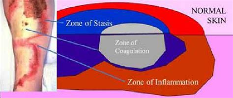 Jackson Burn Wound Model Download Scientific Diagram