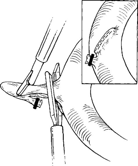 Figure From Laparoscopic Diagnosis And Excision Of Meckel S