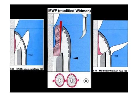 Modified widman flap