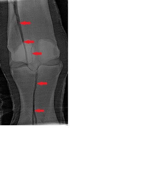 complex, displaced fracture involving the metacarpus and first phalynx ...