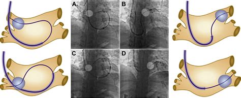 Successful Transseptal Puncture And Cryoballoon Ablation Of Symptomatic