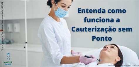 Cauterização O Que É - O que é cauterização sem ponto? - Blog Master Health