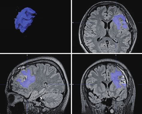 Olumetric Analysis Of Cerebral Edema Blue By Segmentation Of The Download Scientific Diagram