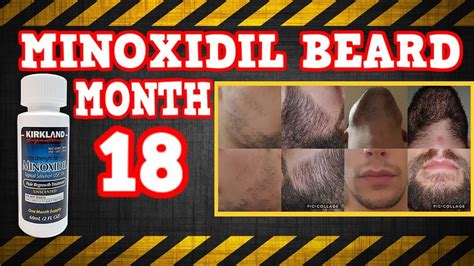 Minoxidil Beard Growth Results Month 18 On Minox For The Beard