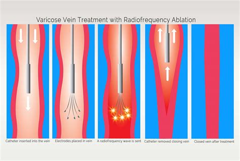 Varicose Vein Removal Pensler Vein Institute Ferndale Michigan