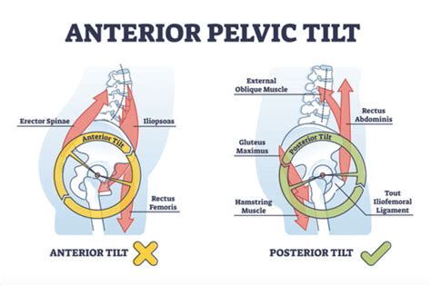 Can A Chiropractor Fix Anterior Pelvic Tilt Evaluating Chiropractic Interventions And Outcomes