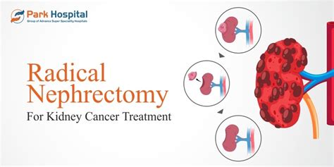 Radical Nephrectomy For Kidney Cancer Treatment Park Hospital