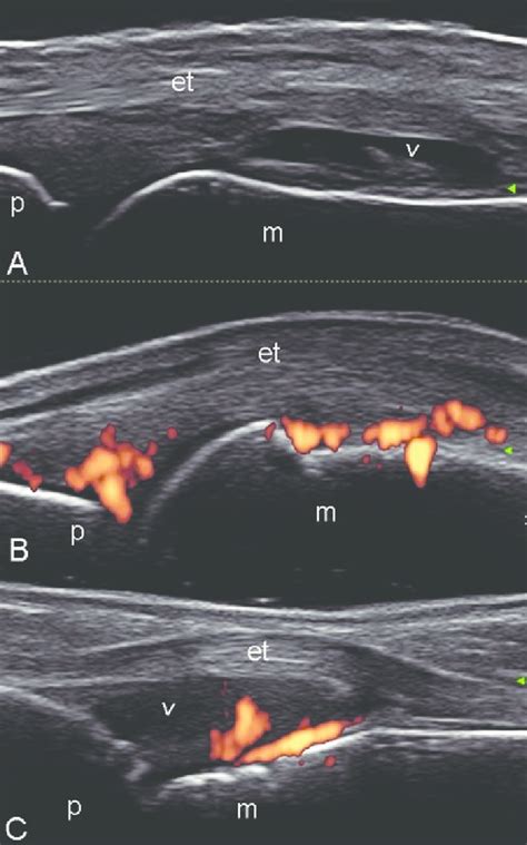 Rheumatoid Arthritis Metacarpophalangeal Joints Dorsal Longitudinal Download Scientific