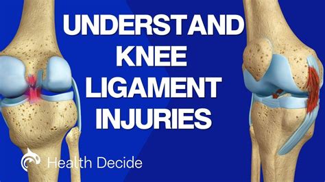 Knee Ligament Injuries Acl Pcl Mcl Lcl 3d Animation