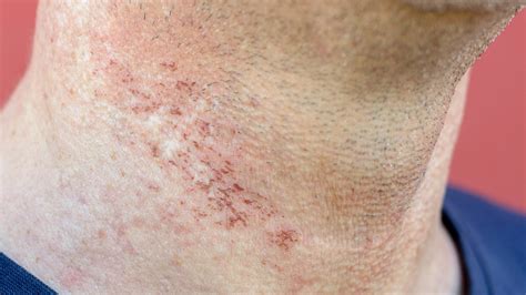 What to Know About Laser Hair Removal Burns