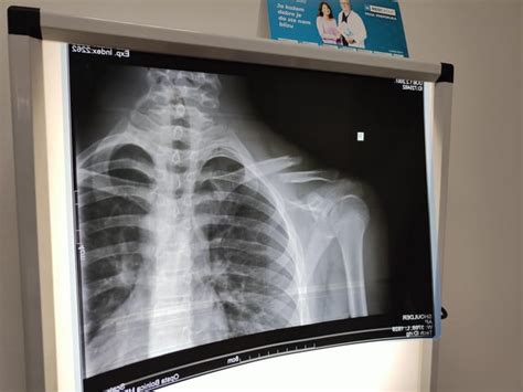 Do i need surgery for my collarbone? : r/medical