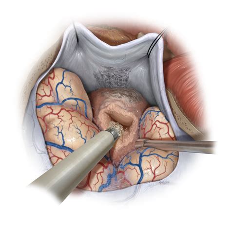 Medial Sphenoid Wing Meningioma The Neurosurgical Atlas