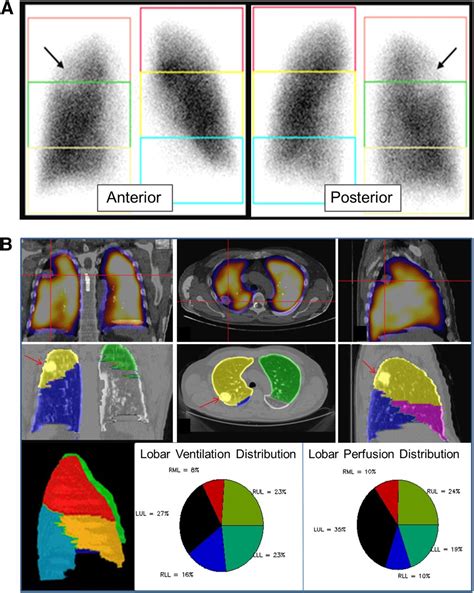 Vq Scanning Using Spect And Spectct Journal Of Nuclear Medicine