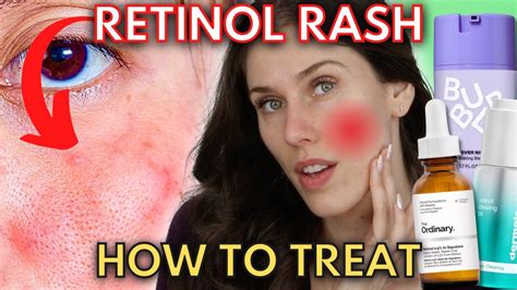 Do You Have A Retinol Rash Or Are You Experiencing Retinization Youtube