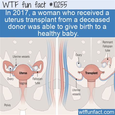 WTF Fun Fact – Uterus Transplant Success | Read More