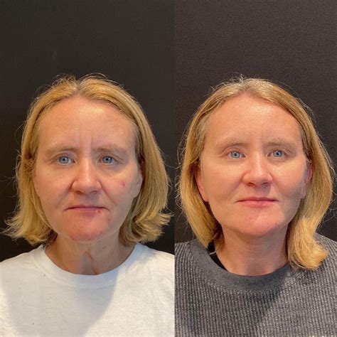 Facelift And Neck Lift Austin Tx Dr Weinfeld