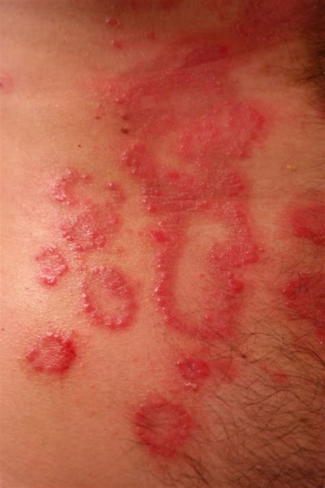 Skin Condition – Psoriasis - Anytime UVB