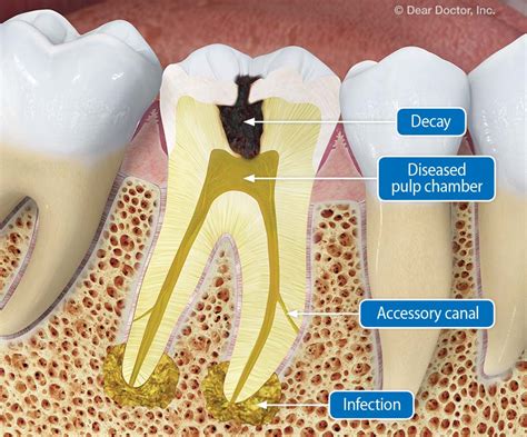 Why See An Endodontist