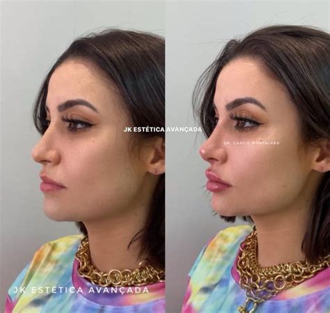 Topo Imagem Boca Rosa Antes E Depois Da Lipo Br Thptnganamst Edu Vn