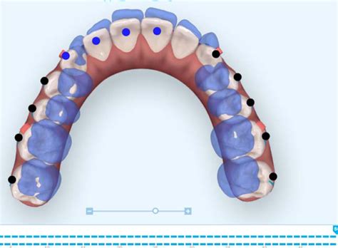 Fig 3b Upper Occlusal View Of The First Digital Treatment Plan Clincheck 1