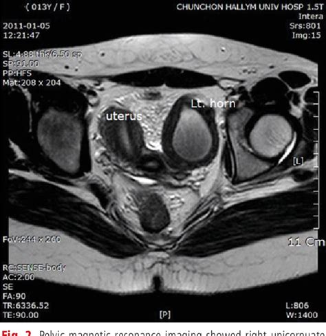 Figure 2 From A Case Of Laparoscopic Management Of Unicornuate Uterus