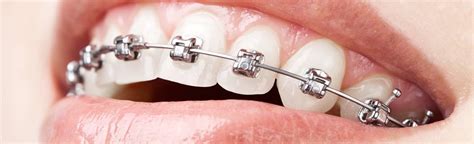 Brackets Orthodontiques Connaissez Tous Les Types Leurs Utilisations