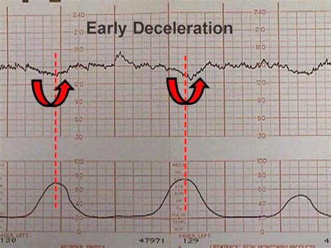 What Is Early Fetal Heart Rate Deceleration