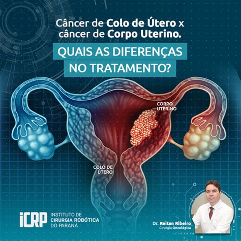 Quais as diferenças no tratamento de Câncer de Colo de Útero X Câncer