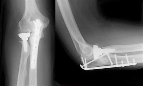 Elbow Fracture Treatment | Elbow Bone Fracture Surgery