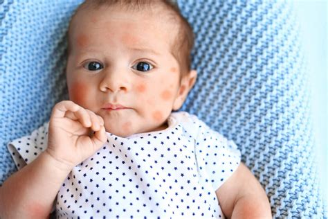 Eczema in babies: everything you need to know