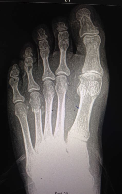 Treating Lesser Metatarsal Stress Fracture Following A First Mpj