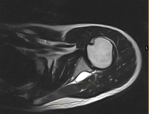 Spinoglenoid Ganglion Cyst With Isolated Infraspinatus Atrophy Sumer