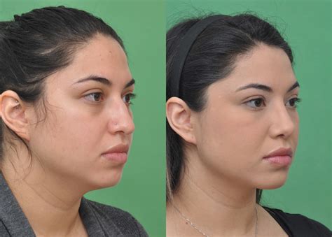 Neck Liposuction Gallery Top Plastic Surgeon In Mclean Va