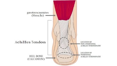 Achilles Tendinopathy Nhs Lanarkshire