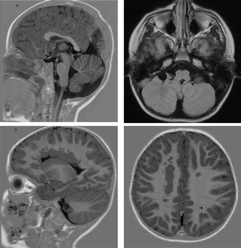 Fig S16 Mri Dilated Cisterna Magna Or Cerebellomedullary Cistern