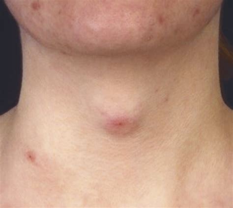 Dermoid Cyst Neck