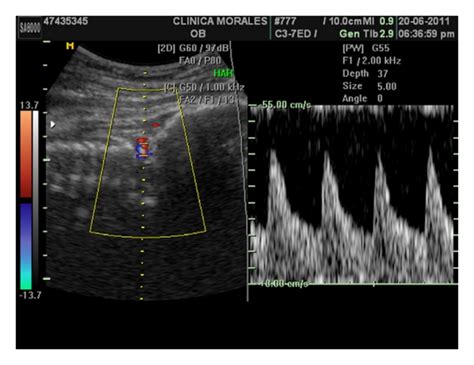 Week 20 Transvaginal Colour Doppler Ultrasound The Aberrant Cotyledon