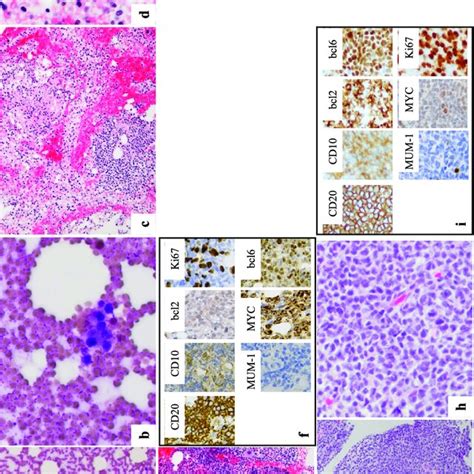 Pathological Examinations In Case 1 A B Bone Marrow Aspiration Download Scientific Diagram