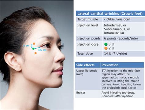 Consensus Recommendations On The Aesthetic Usage Of Botulinum Toxin