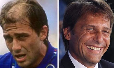 Did Antonio Conte Have A Hair Transplant Operation